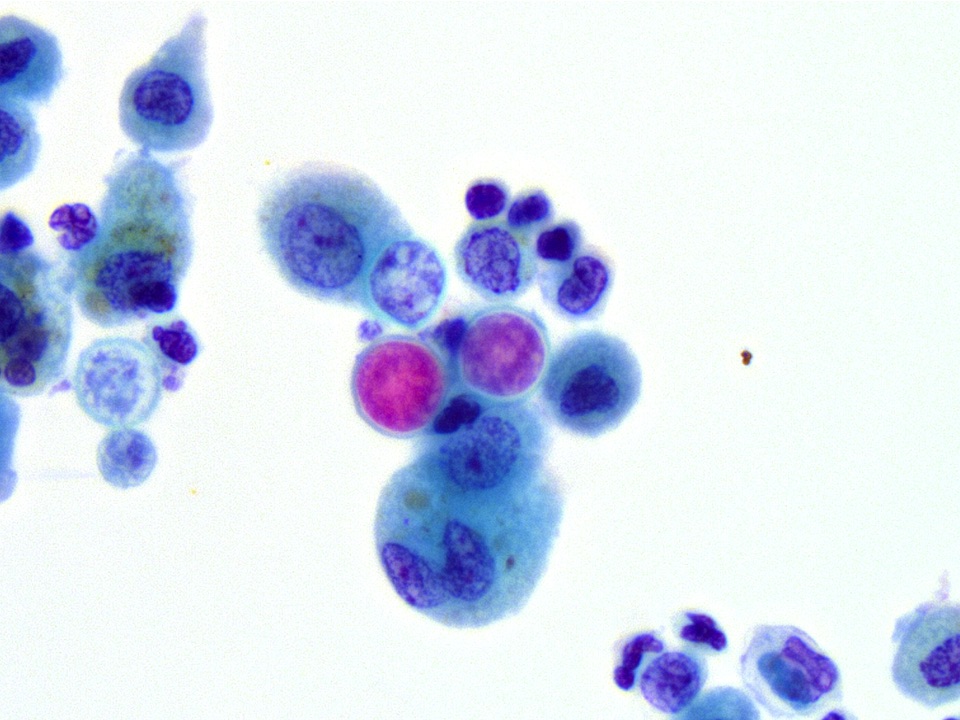Blastomyces, a fungal organism that causes lung inflammation which can mimic a tumour.