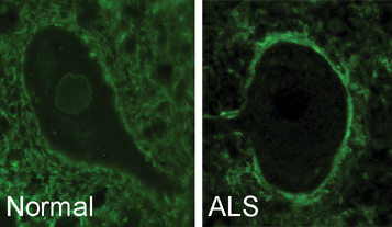 Antibodies surround a healthy motor neuron cell (left) and move to the outer cell membrane in ALS (right).
