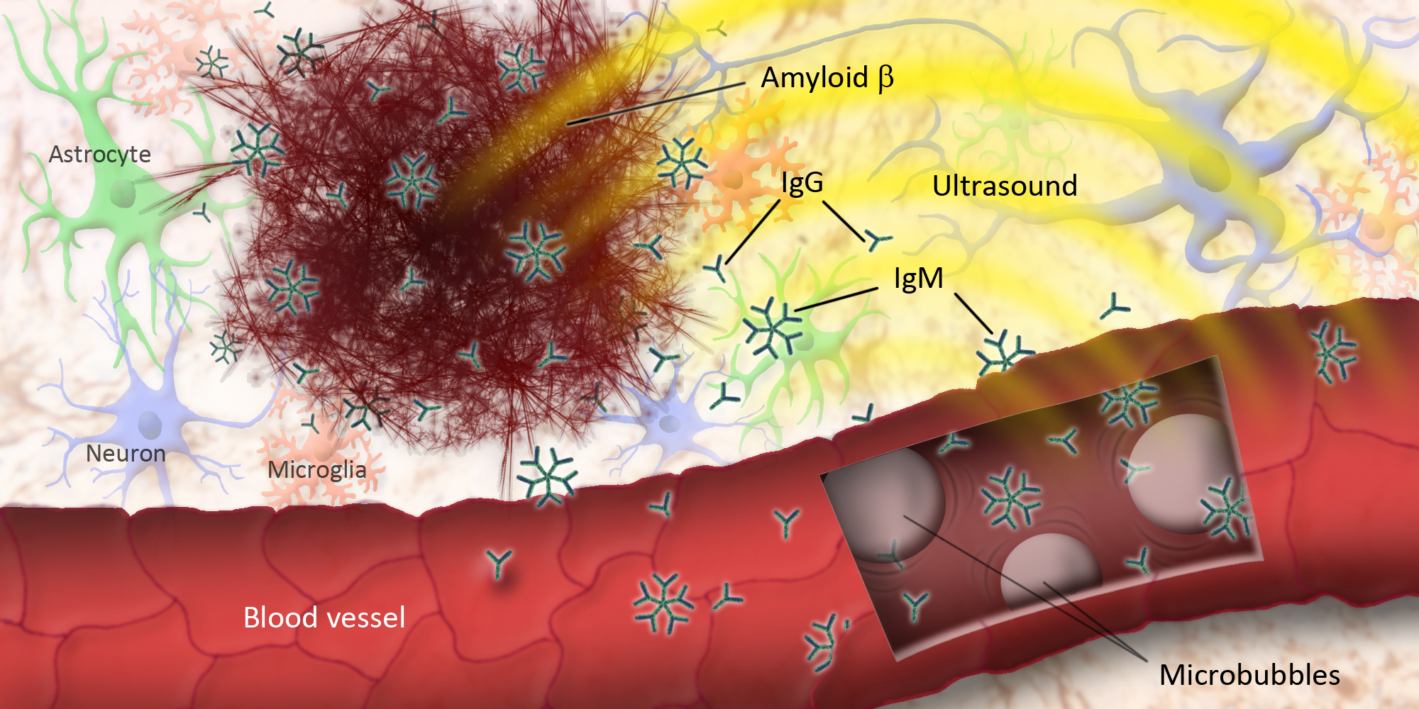 Ultrasound vibrates microbubbles injected into the blood, allowing natural antibodies (IgG and IgM) and glial cells (astrocytes and microglia) to clear amyloid-beta from the brain. 