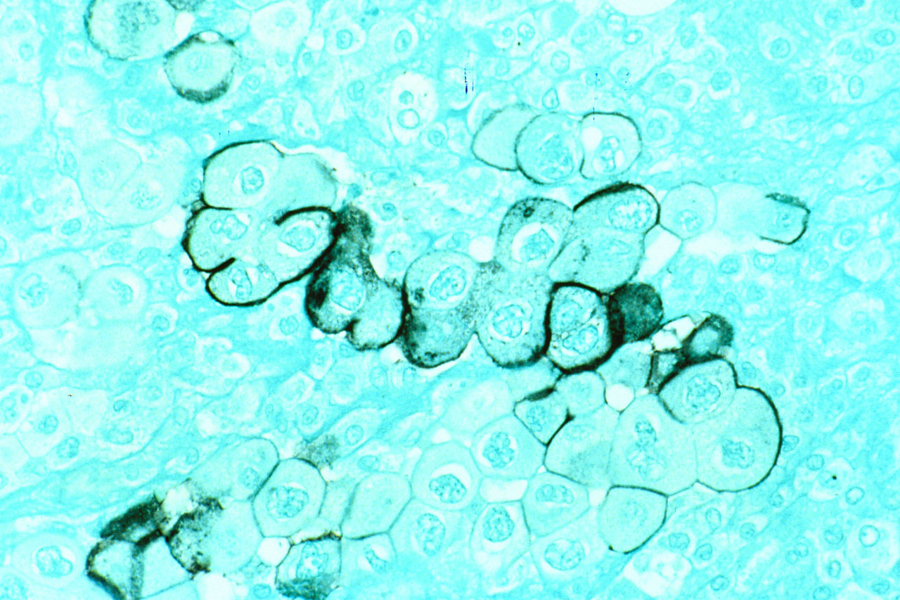 Pancreatic cancer cells, courtesy of National Cancer Institute, Wikimedia Commons
