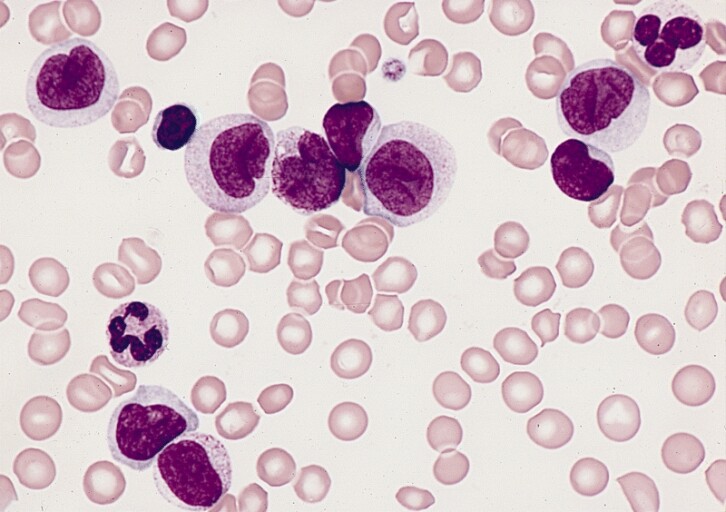 Leukemia Cells
