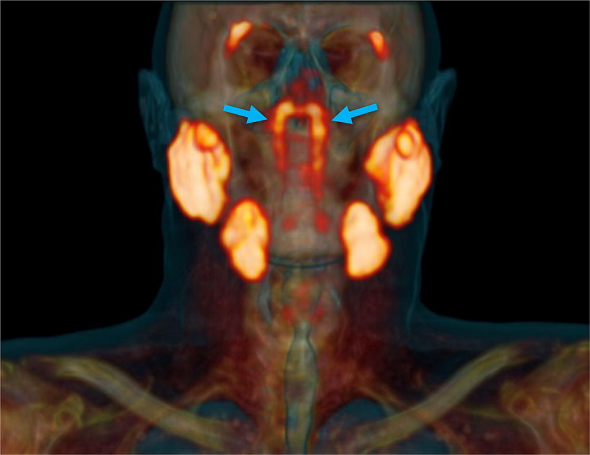 Image shows tubarial glands